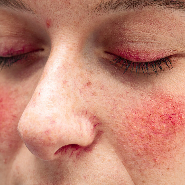 A close up view on the face of a young caucasian lady, suffering from a severe case of rosacea, with facial redness and dilated blood vessels of the eyelids, nose and cheeks.