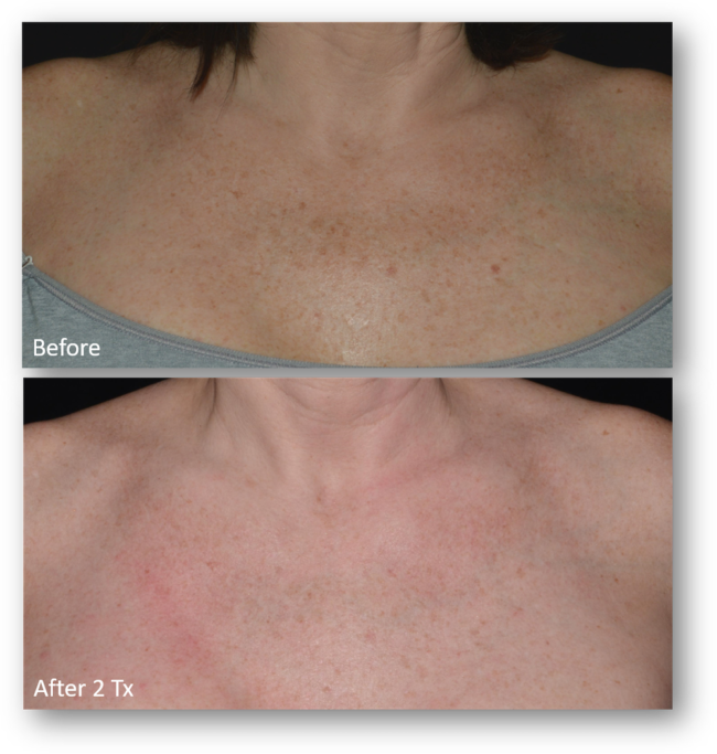 LaseMD Ultra B&A (23)