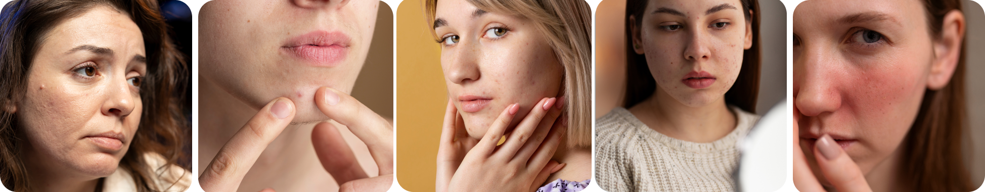 Acne Scarring