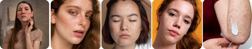 Acne and Breakouts (1)