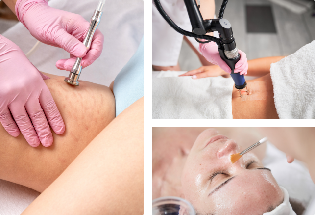 Skin Peels for Stretch Marks